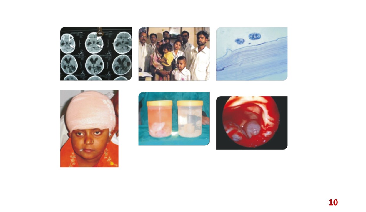 Hydatid cysts details and jars