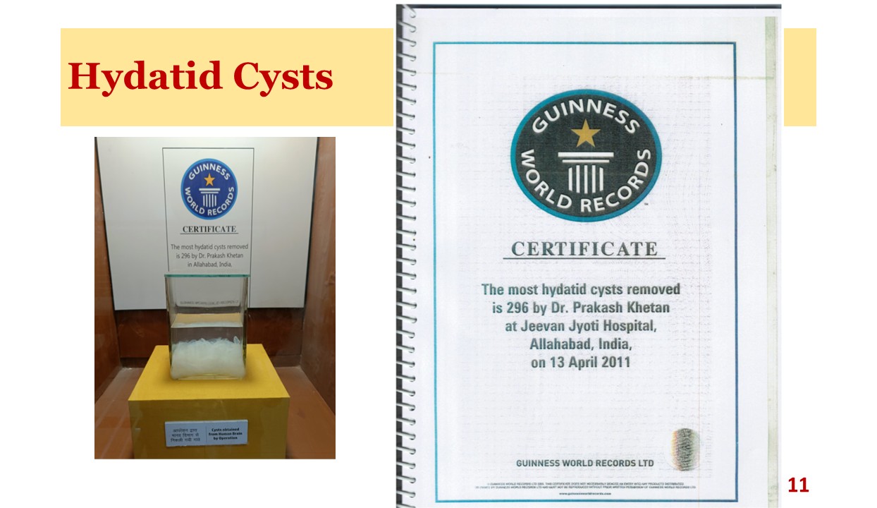 Guinness World Record for 296 Cysts