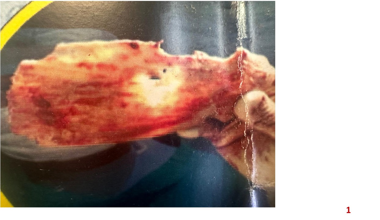 240g Giant Meningioma Extracted