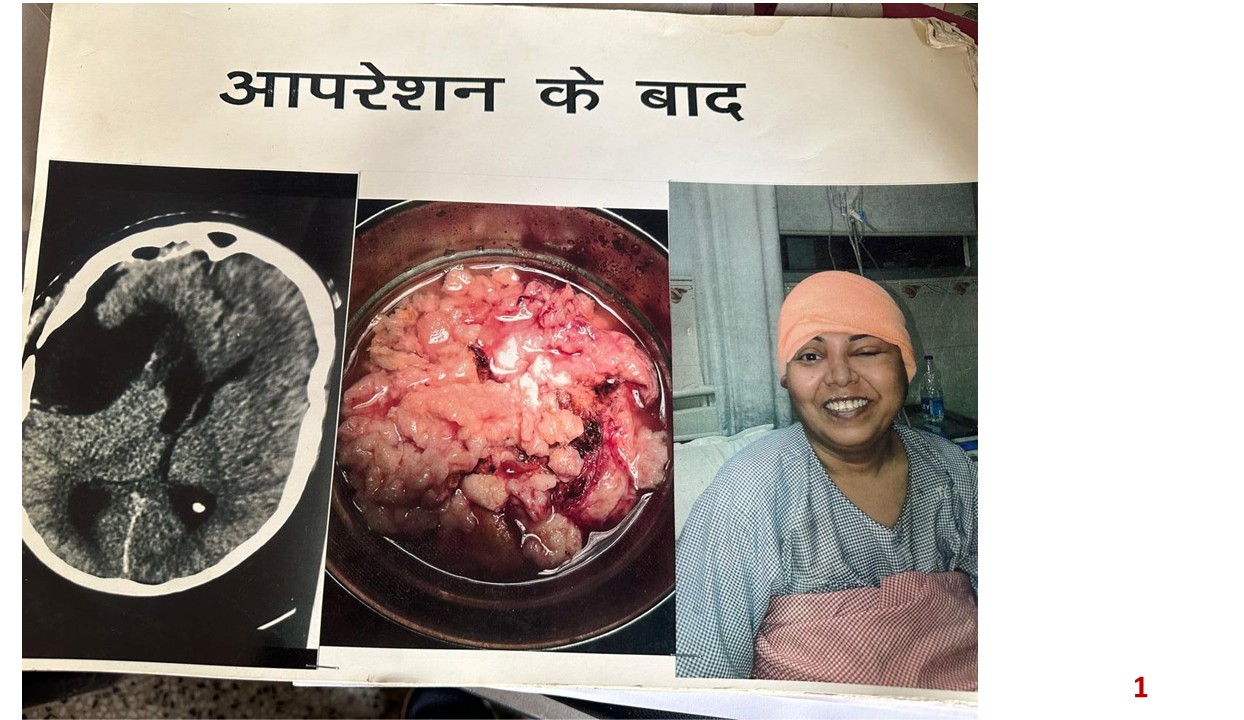 Post-operative MRI and Extracted Tumor