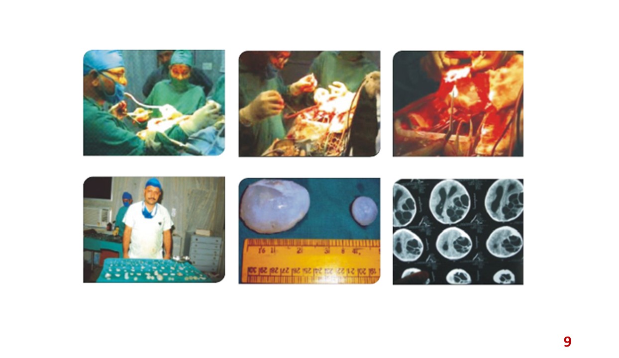 Hydatid cysts surgery collage